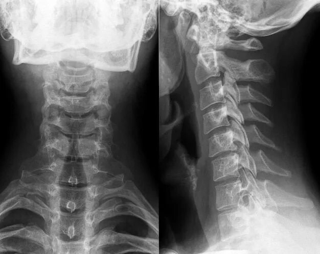 Radiografía de la columna lumbar, perfil Columna lumbar, Lumbares, Columnas