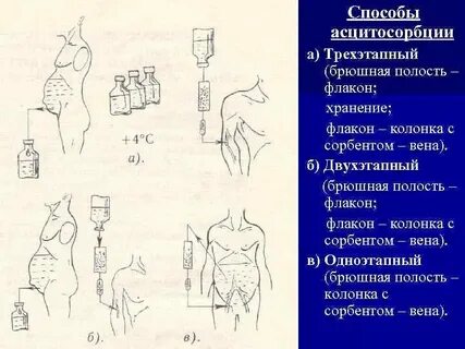 Интоксикация брюшной полости