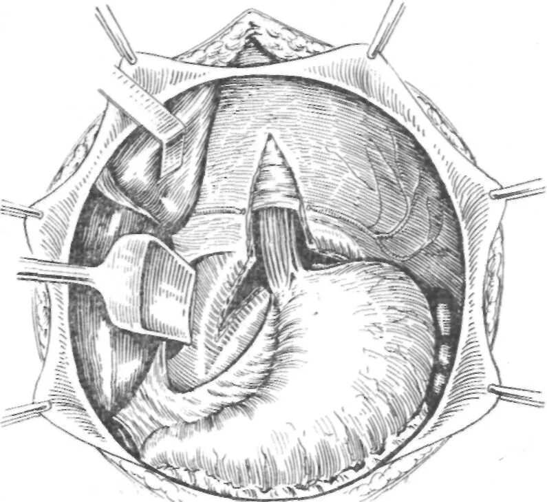 Трансуретральная резекция аденомы простаты. Биполярная резекция. Режимы биполярной коагуляции. Парауретральные железы простата. Биполярная резекция.