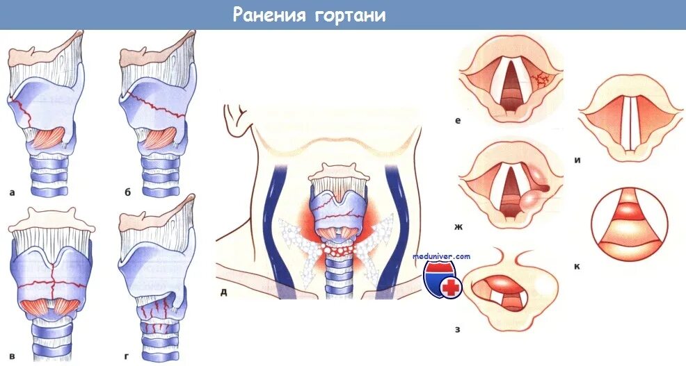 Гортань впр