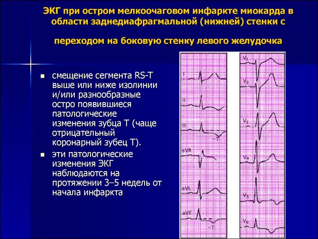 Инфаркт миокарда передней стенки ЭКГ. Мелкоочаговый и крупноочаговый инфаркт на ЭКГ. Острый Нижний заднедиафрагмальный инфаркт миокарда ЭКГ. Основной ЭКГ признак мелкоочагового инфаркта миокарда. Нарушение реполяризации передне перегородочной области