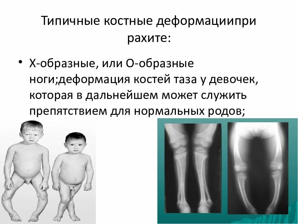 Костные проявления рахита. Рахит деформации костей. Деформация конечностей при рахите. Течения рахита