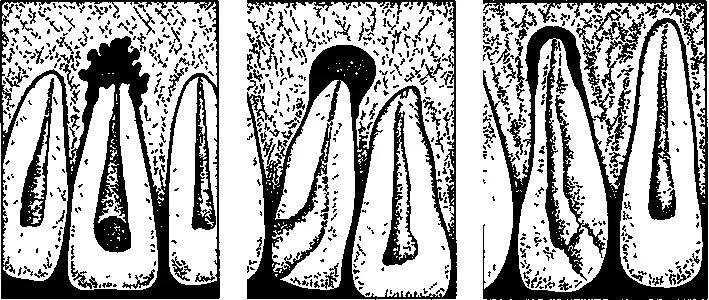 Фиброзный периодонтит. Периодонтит фиброзный гранулематозный гранулирующий. Хронический гранулематозный периодонтит клиника. Хронический гранулирующий периодонтит диагностика. Хронический верхушечный гранулирующий периодонтит.