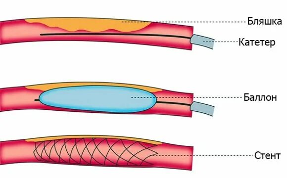 Баллонная ангиопластика и стентирование. Баллонная ангиопластика коронарных артерий. Ангиопластика сосудов нижних конечностей. Стентирование коронарных артерий схема. Ангиопластика цена