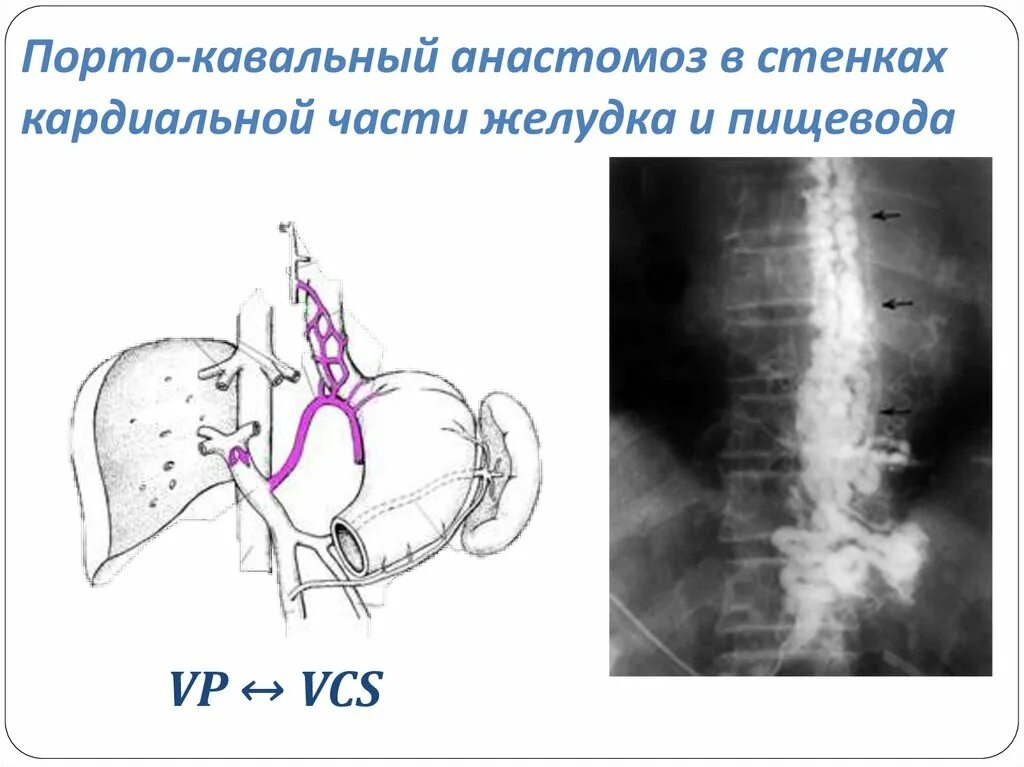 Анастомоз пищевода. Порто-кавальный анастомоз. Спленоренальный анастомоз. Спленоренальный анастомоз операция. Порто кавальные анастомозы желудка.
