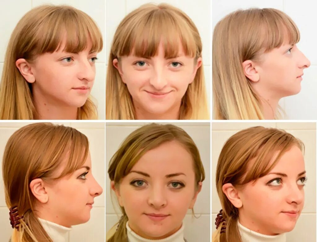 неправильный нос. ринопластика искривление носовой. бурун ринопластика. пластика носа. неправильный нос.