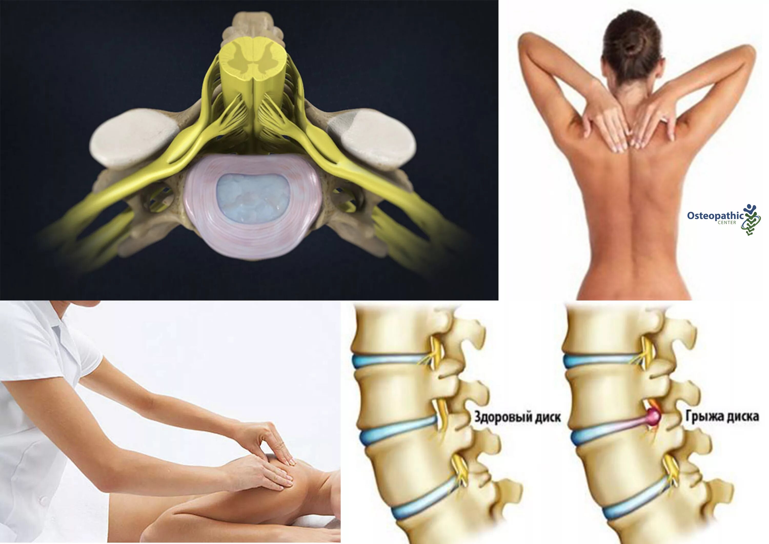 Грыжи дисков поясничного отдела позвоночника. Протрузия шейного отдела позвоночника. Протрузия межпозвонковых дисков шейного. Протрузия диска шейного отдела позвоночника симптомы. Что такое протрузия дисков позвоночника поясничного отдела.
