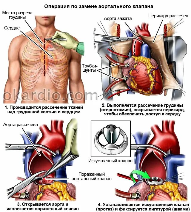 Как клапан делает операция. Шунтирование клапана сердца. Операция на сердце аортальный клапан. Коронарное шунтирование сосудов сердца.