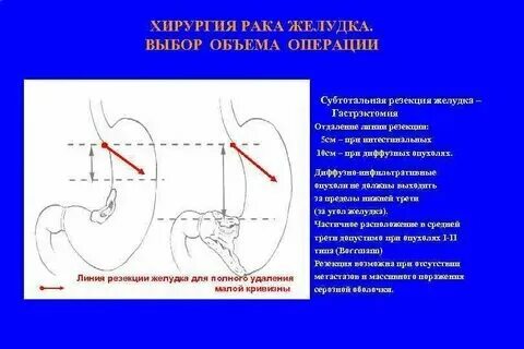 Удаление желудка сколько живут