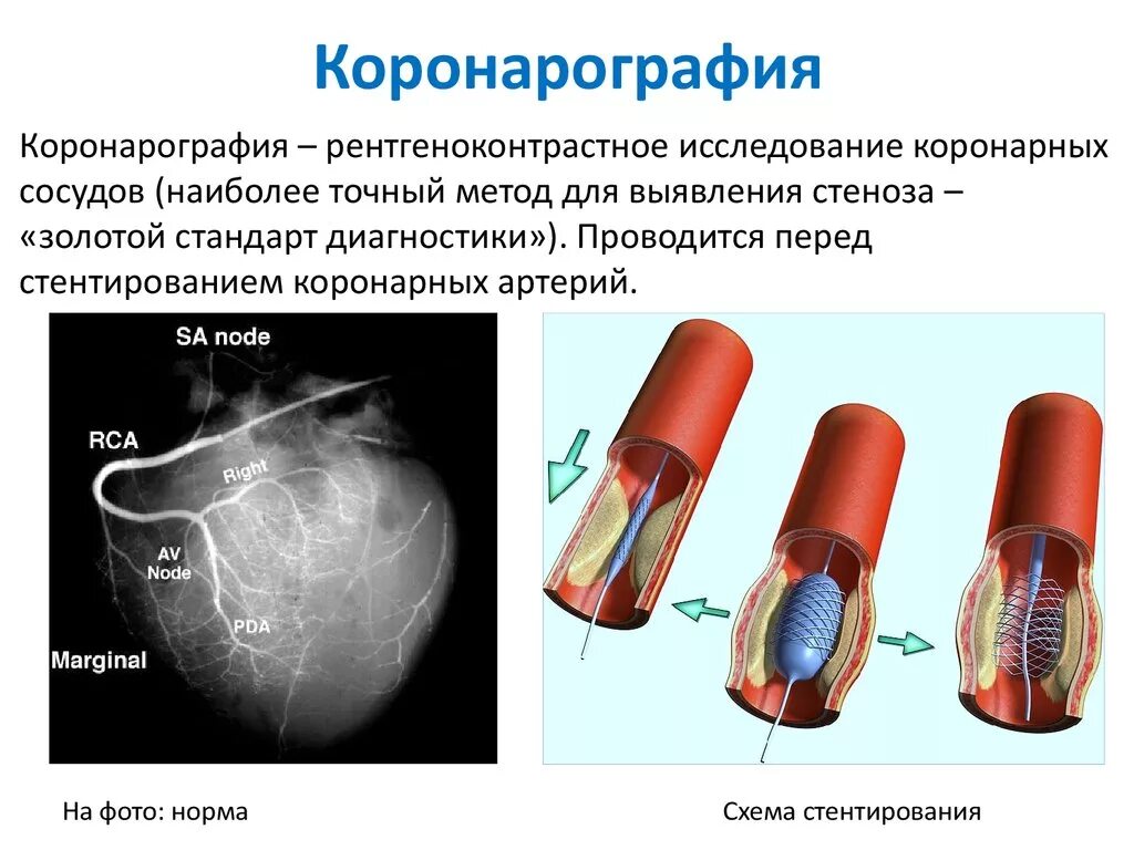 Стентирование сосудов последствия. Коронарное исследование сосудов сердца. Ангиография коронарных сосудов. Коронарография ишемия. Обследование сосудов сердца коронарография.