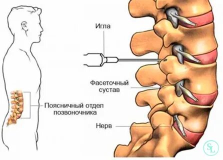 Блокада пояснично крестцового отдела позвоночника при грыже