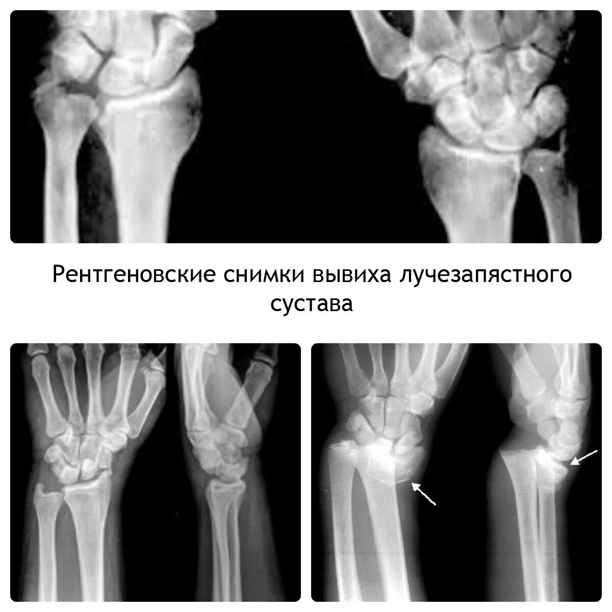 Рентген лучезапястный сустав перелом лучевой кости. Вывих костей запястья рентген. Перелом лучевой кости рентген. Вывив локтевой кости рентген.