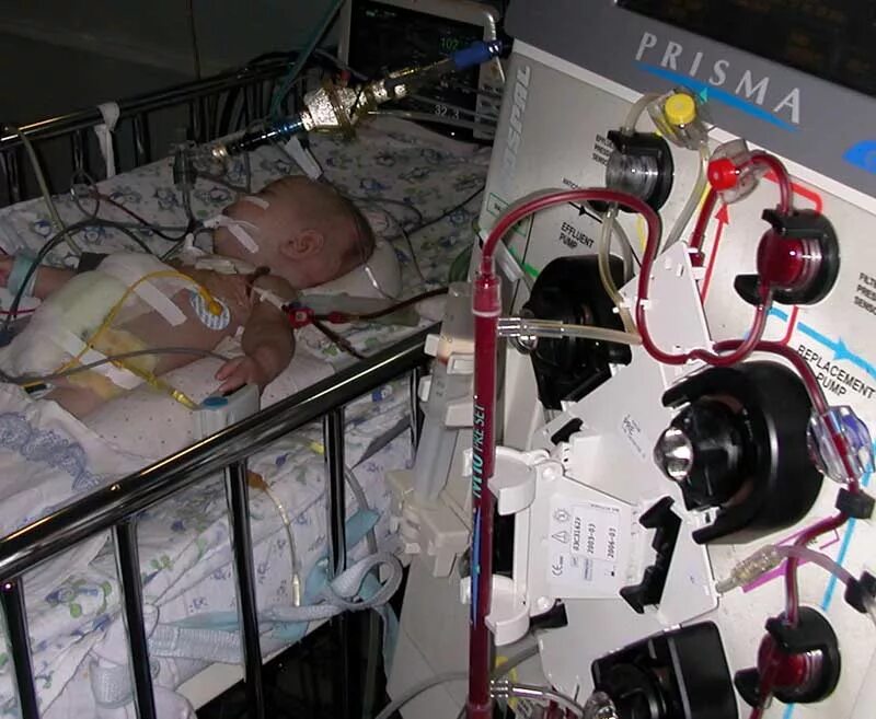 Опн новорожденных. ЭКМО аппарат для новорожденных. Искусственная почка аппарат ЭКМО.