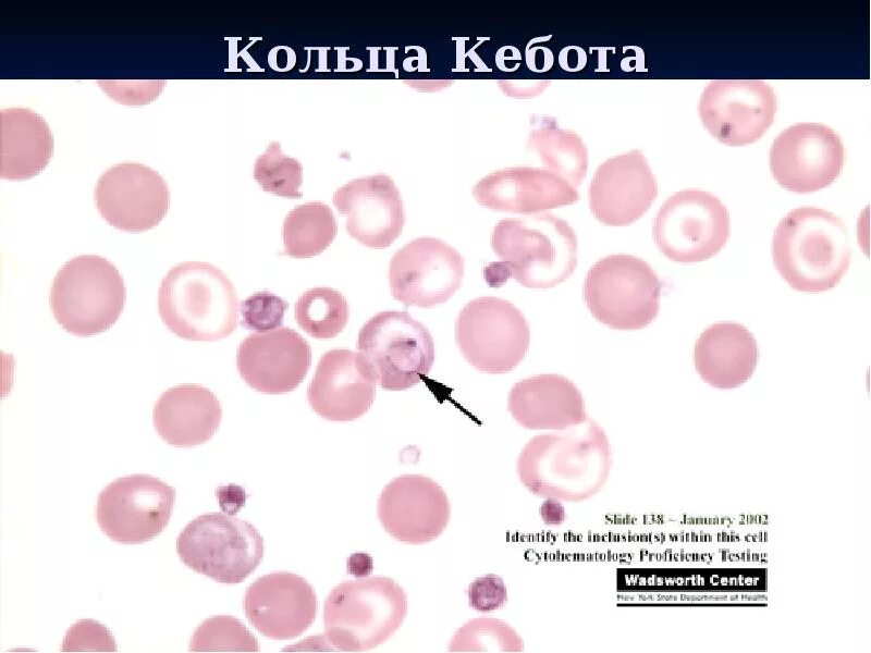 Тельца жолли кольца кебота при какой анемии