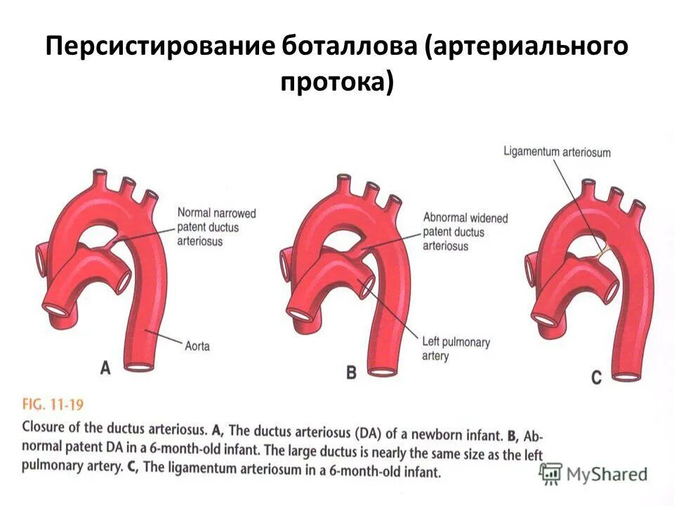 боталлов проток сердца. впс: - открытый баталов проток. боталлов проток (артериальный проток). открытый артериальный (боталлов) проток. впс баталов проток.