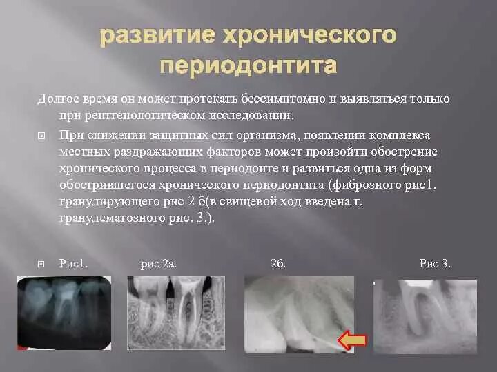 Хронический периодонтит. Осложнения периодонтита. Обострение хронического периодонтита. Осложнение лечения периодонтита