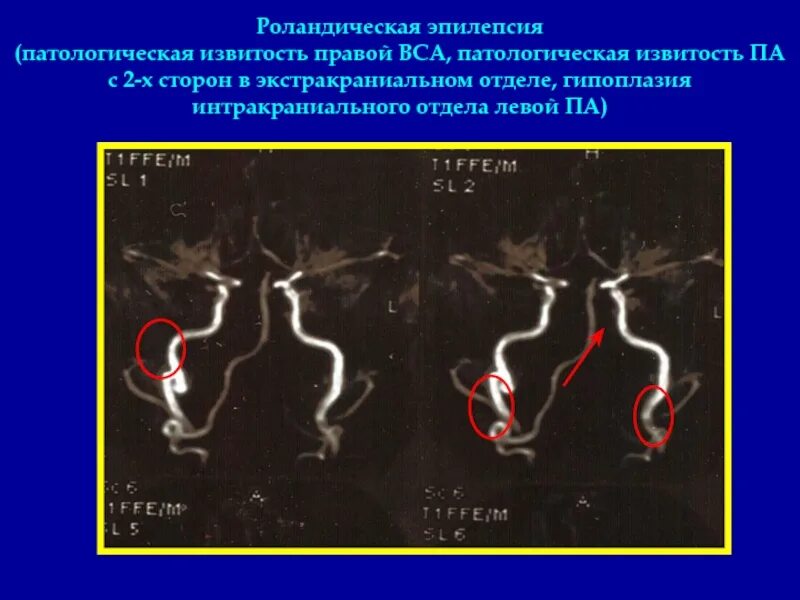 Изгиб вса. Патологическая извитость внутренней сонной артерии. Аневризма позвоночной артерии кт. Патологическая извитость сонных артерий кинкинг. Извитость левой внутренней сонной артерии.