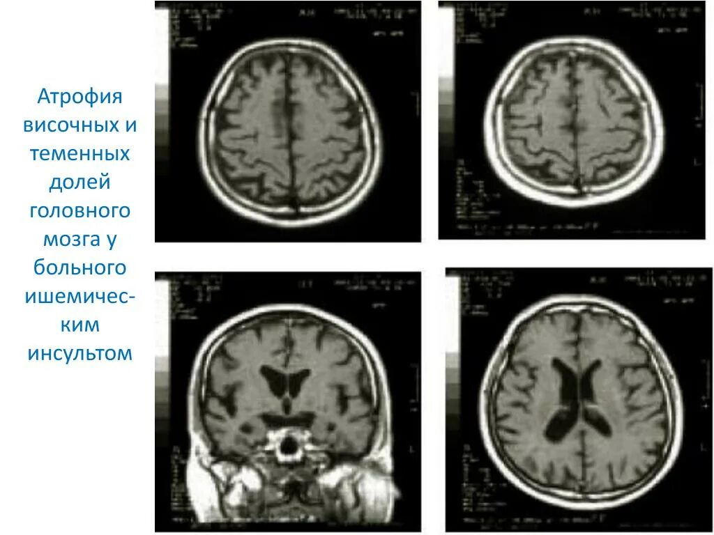 Умеренная атрофия мозга. Атрофия лобных долей кт. Атрофия височных долей головного мозга на мрт. Атрофия лобных долек кт. Атрофия лобных долей мрт.