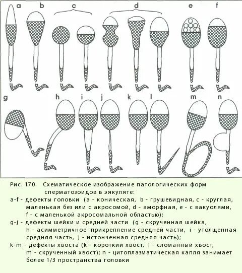 Патологические спермограмма. Патологическая морфология спермограммы. Патологические спермограмма. Спермограмма олигозооспермия. Спермограмма патология головки норма.