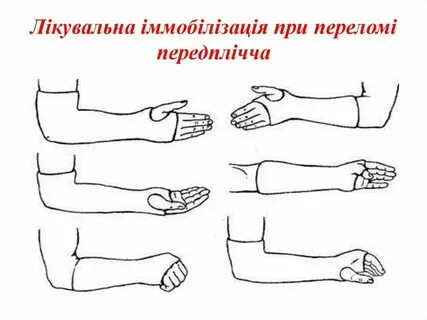 Сколько ходить в гипсе при переломе руки