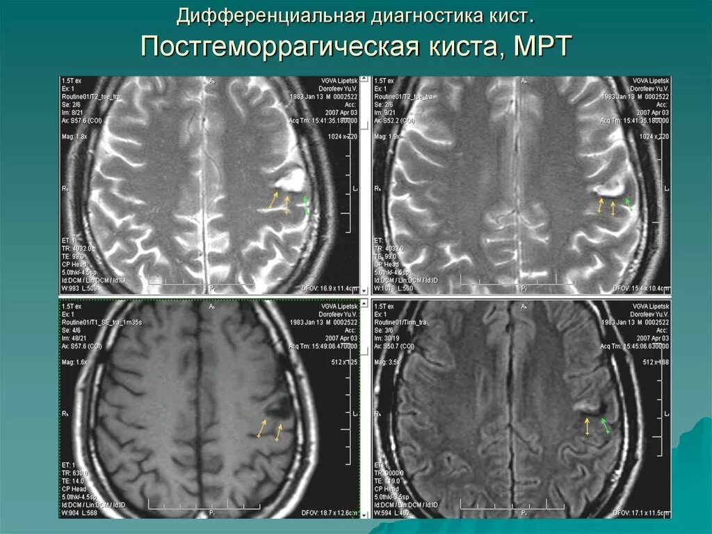 Ишемия мозга мрт. Мрт головного мозга при ишемическом инсульте. Ишемический инсульт мрт снимок. Постгеморрагическая киста головного мозга мрт. Мрт головного мозга геморрагический инсульт.