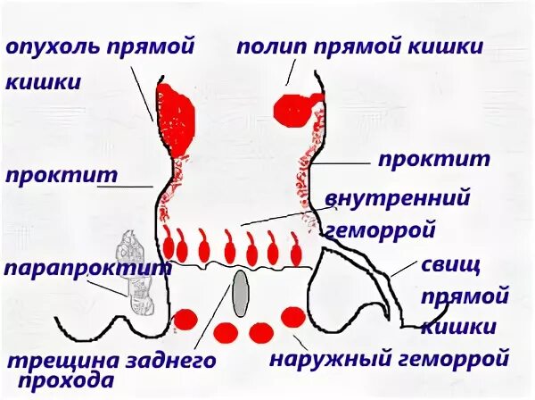 Колет в задний. Боль отдающая в прямую кишку. Болит прямая кишка и низ живота.