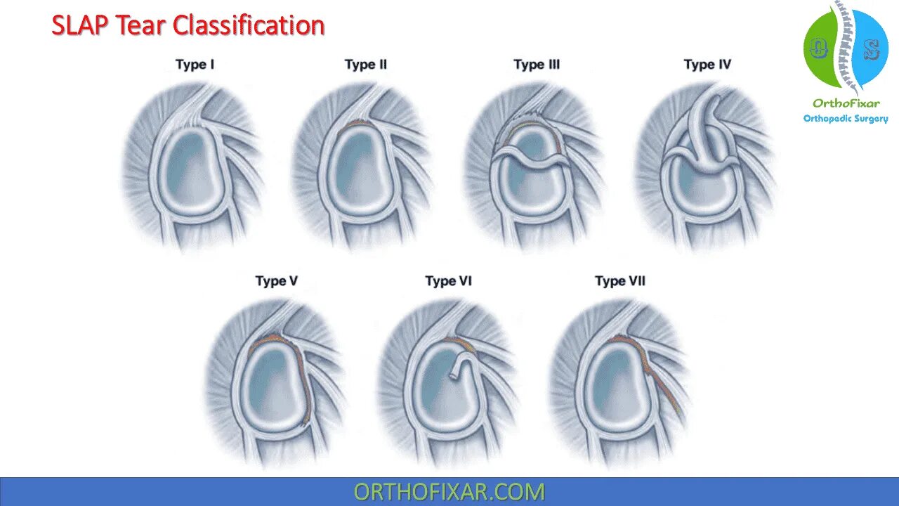 Slap повреждение плечевого сустава. Slap синдром плечевого сустава мрт. Повреждение суставной губы плечевого сустава slap. Slap синдром плечевого сустава классификация.