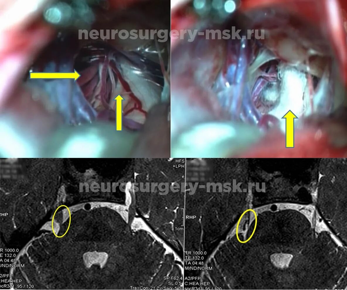 Микроваскулярная декомпрессия тройничного. Невралгия тройничного нерва нейроваскулярный конфликт. Микроваскулярная декомпрессия корешка тройничного нерва. Операция на тройничный нерв. Мрт лицевого нерва