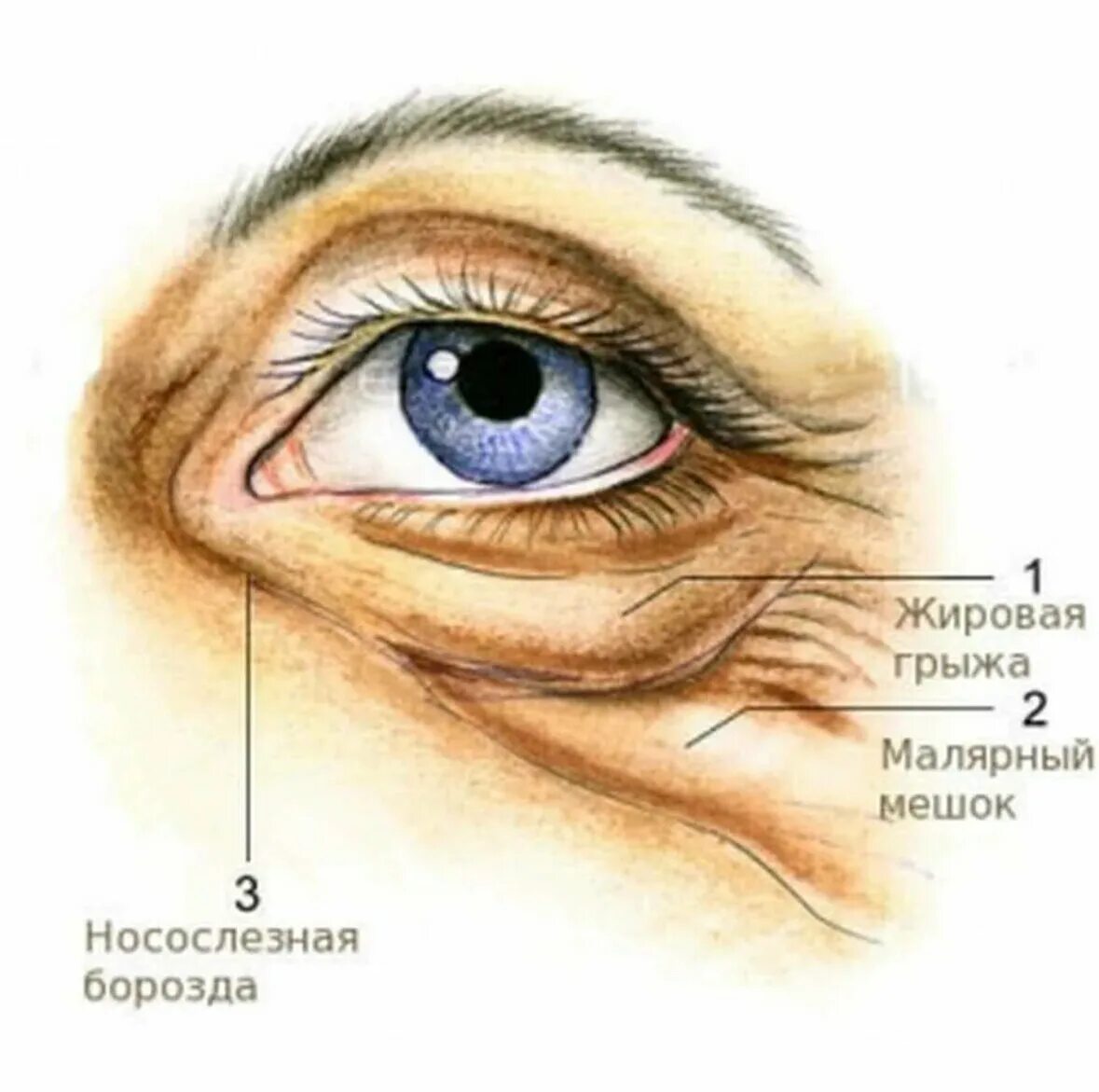 Малярный мешок слезная борозда. Грыжа, малярный мешок, носослёзная борозда. Грыжа Нижнего века и малярные мешки. Параорбитальные грыжи нижних век.