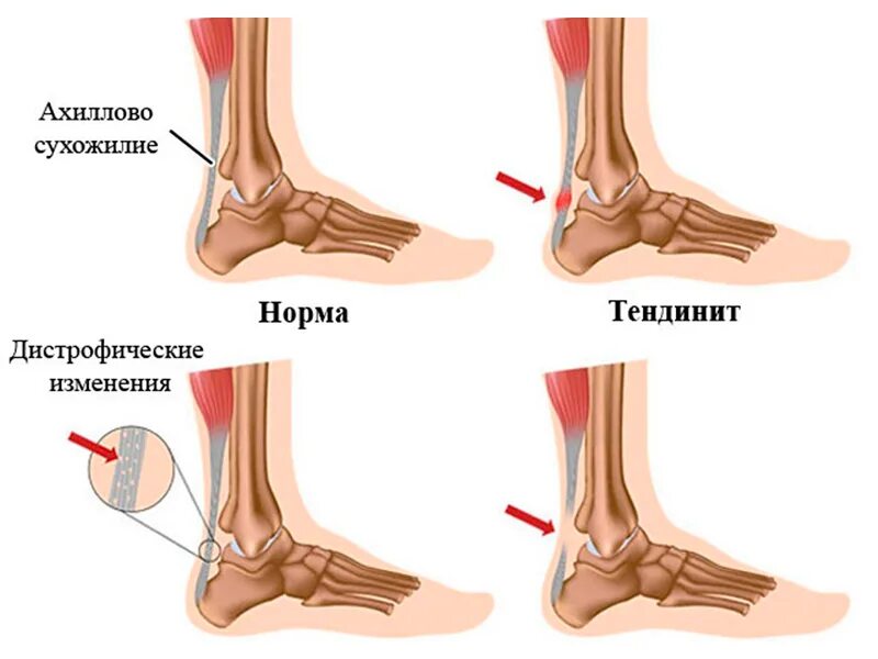 Боль в области голеностопного сустава. Тендиноз ахилиллого сухожилия. Растяжение ахиллова сухожилия (тендинит). Тендинит пяточного ахиллова сухожилия.