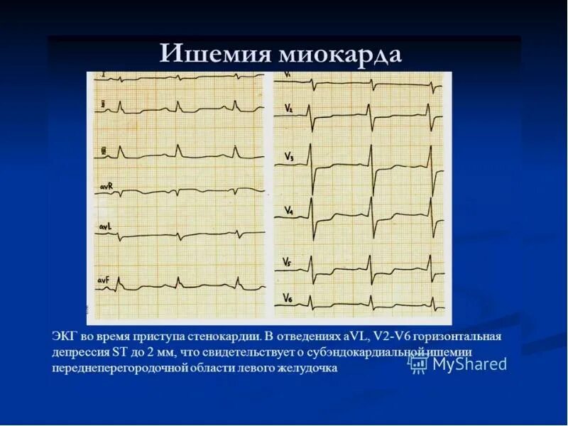 экг левого желудочка. экг гипертрофия левого желудочка заключение. экг левого желудочка. экг левого желудочка. экг при гипертрофии левого желудочка.