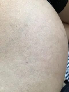 Растяжки на ягодицах