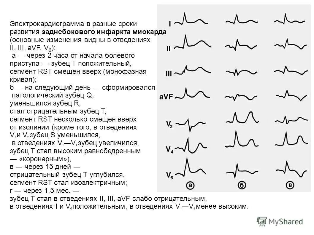 Отведение v1 на экг. 3 Стандартное отведение ЭКГ. ЭКГ зубец т v 1. 2 Отведение ЭКГ. Инфаркт миокарда ЭКГ отведения.