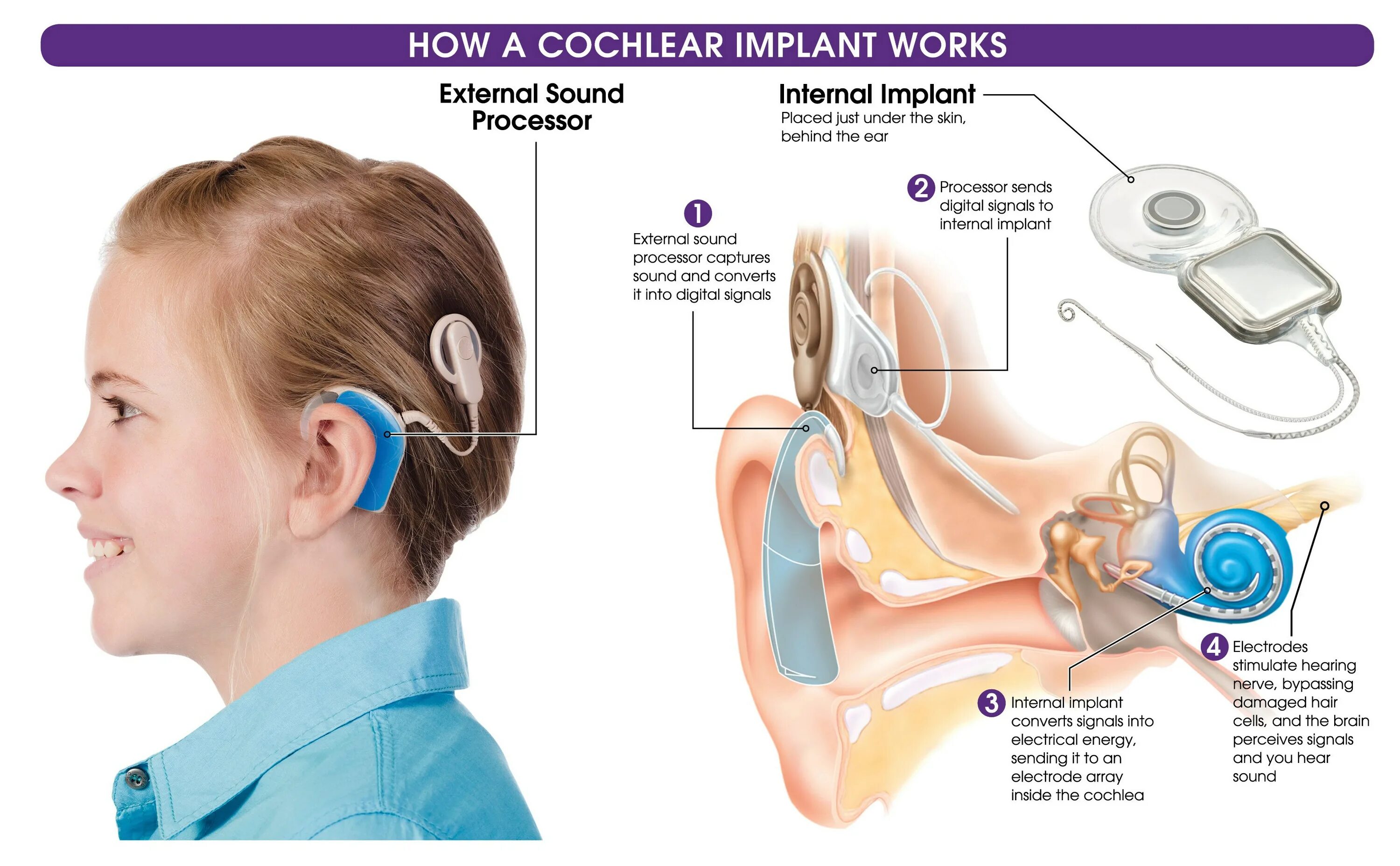 Операция на ухо на слух. Аппарат Cochlear кохлеарный. Кохлеарный имплант кохлеар. Кохлеарная имплантация схема. Аппарат для глухих кохлеарная имплантация.