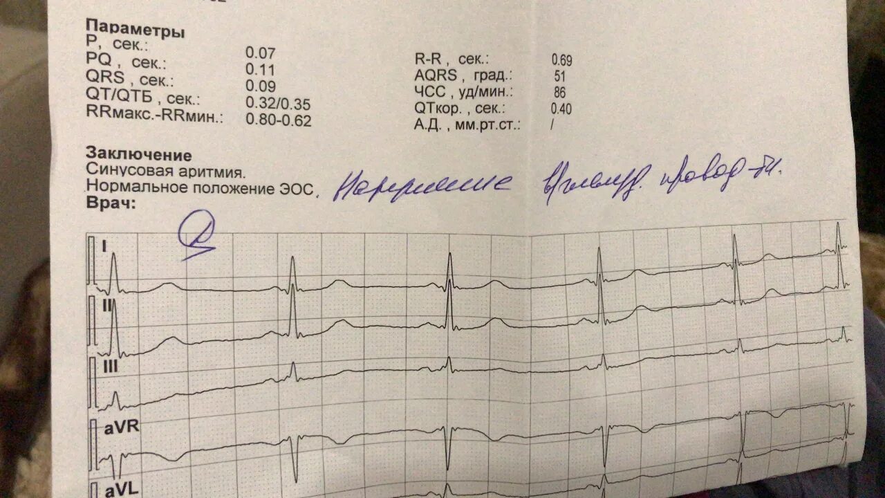 Заключение ЭКГ синусовая аритмия. Синусовая аритмия на ЭКГ расшифровка. Синусовая аритмия на ЭКГ. Нормы по ЭКГ синусовая аритмия.
