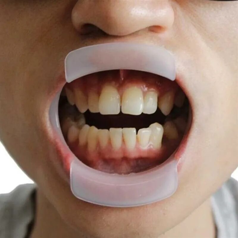 Кап рта. Ретрактор стоматологический силиконовый. Стоматологическая Капа силиконовая расширитель. Стоматологическая распорка для рта. Фиксатор для рта стоматологический.