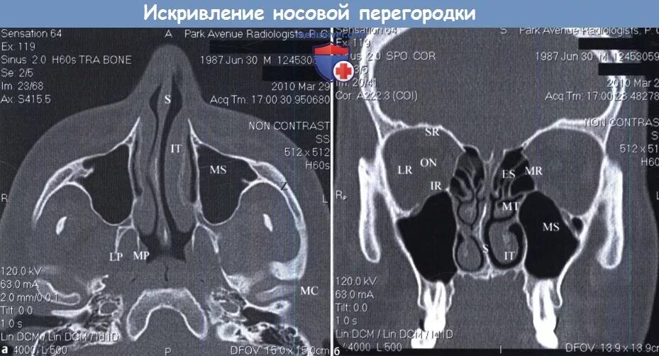 Кт искривленной носовой перегородки. Носовая перегородка анатомия кт. Носовые раковины на кт анатомия. Искривление носовой перегородки кт. Носовая перегородка код по мкб 10