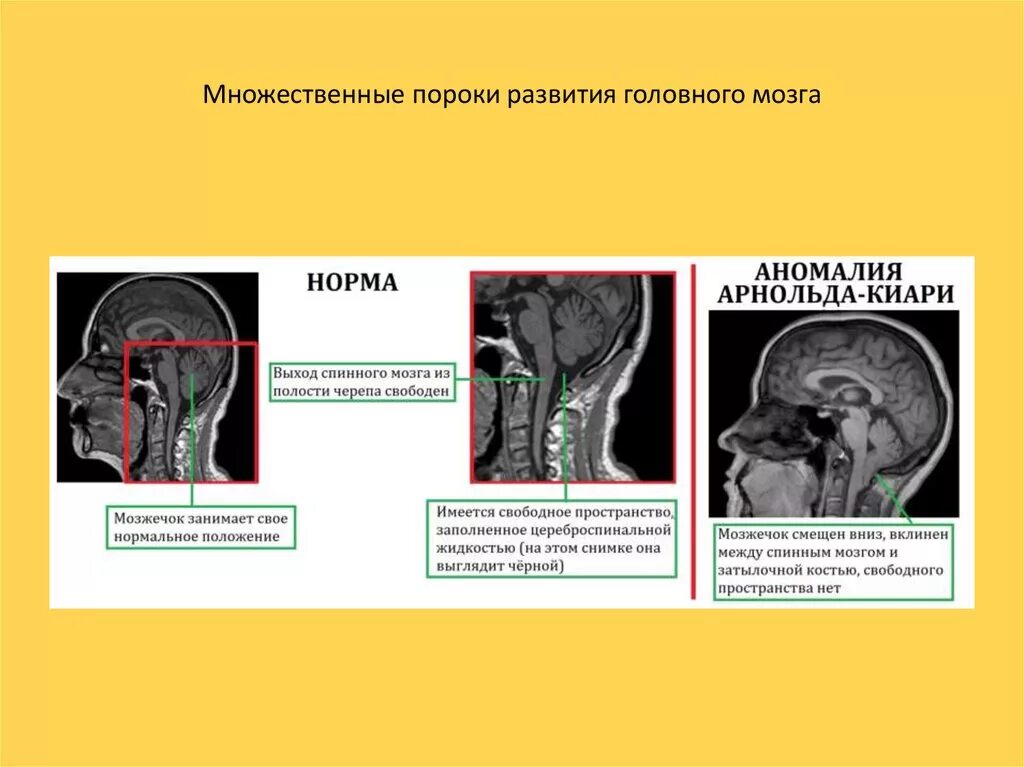 Аномалия развития головного мозга Арнольда Киари. Арнольда Киари аномалия у плода. Пороки развития головного мозга. Пороки развития головного ОМЗНА.