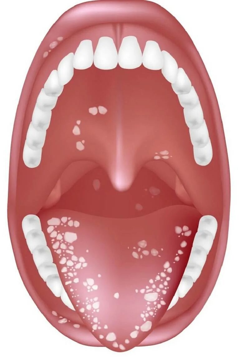 Кандидозный стоматит полости рта. Язык ротовой полости