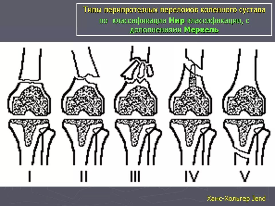 Перелом коленного сустава мкб. Перипротезные переломы коленного сустава. классификация перипротезных переломов коленного сустава. классификация ванкувер перипротезные переломы. ванкуверская классификация перипротезных переломов бедра.