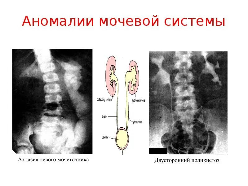 Аномалии развития мочевыделительной системы. Врожденные аномалии развития мочевыделительной системы. Аномалии мочевыводящих. Аномалии развития органов мочеполовой системы. Пороки развития верхних мочевых путей классификация.