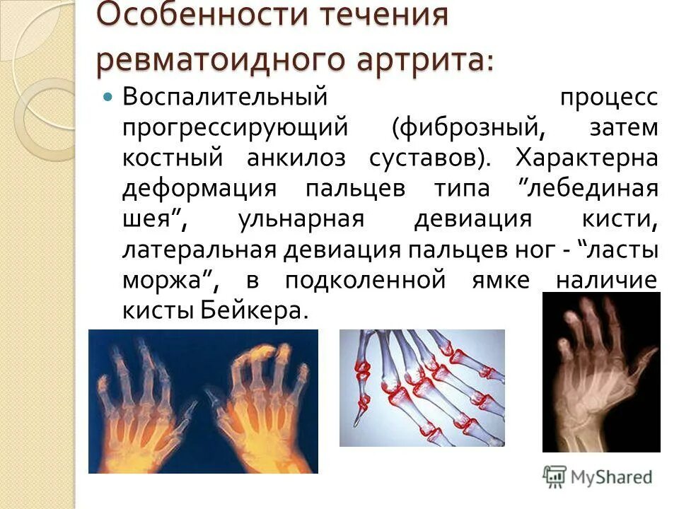 течение ревматоидного артрита