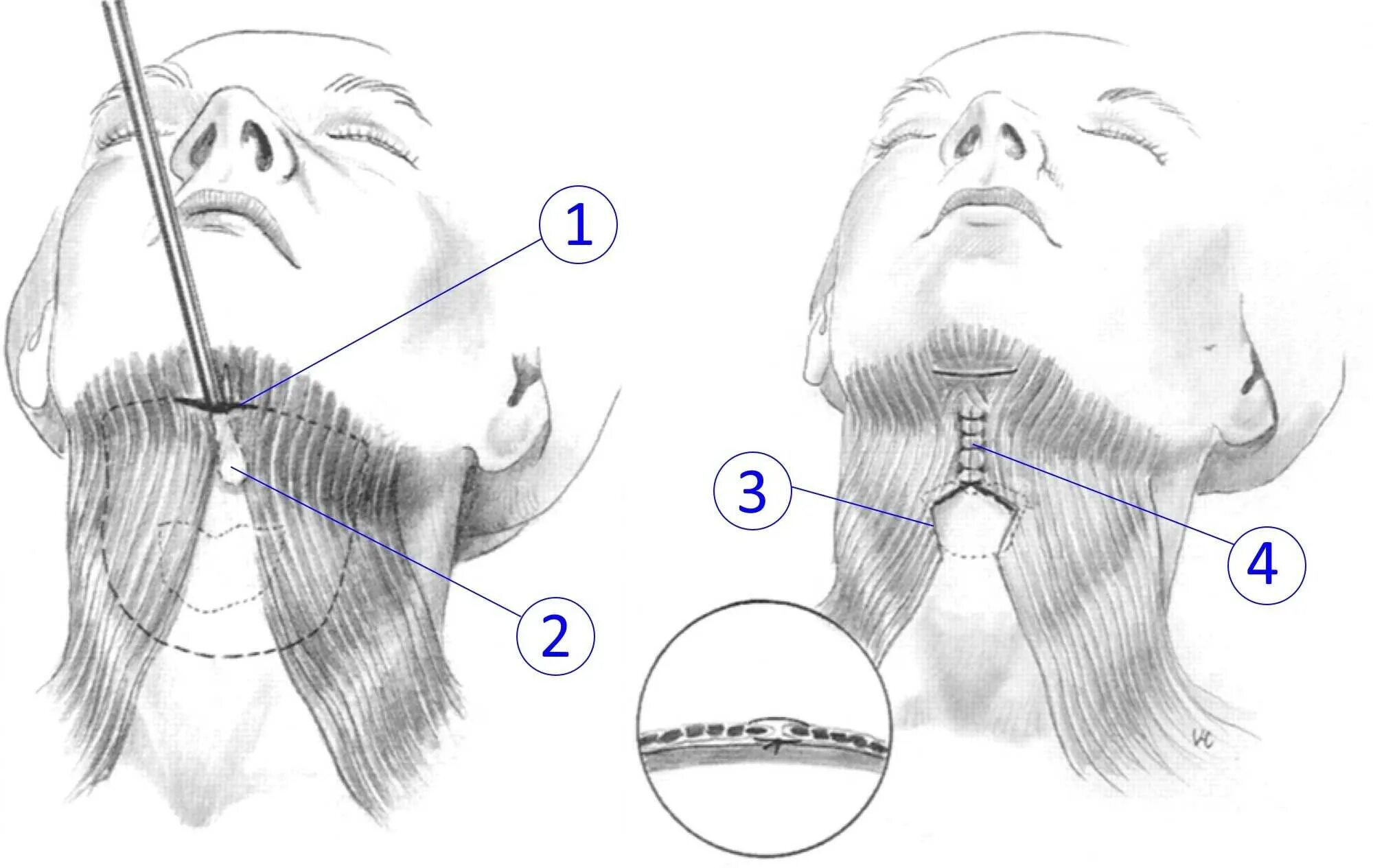 Схема подтяжки лица. Платизмопластика метод. Подтяжка платизмы операция.