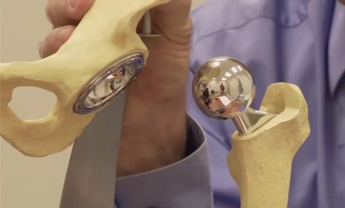 Эндопротез зиммер коленного сустава. Протезирование суставов спб. Коленный эндопротез зиммер. Протез smith nephew. Биполярный тазобедренный протез.