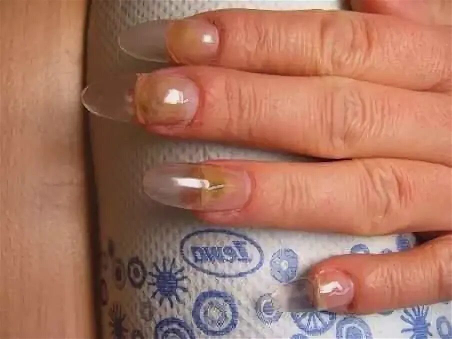 синкгеойная псивдомания. ониходистрофия - онихолизис. онихолизис синегнойная. плесень под гелем. синегнойная псевдомония.