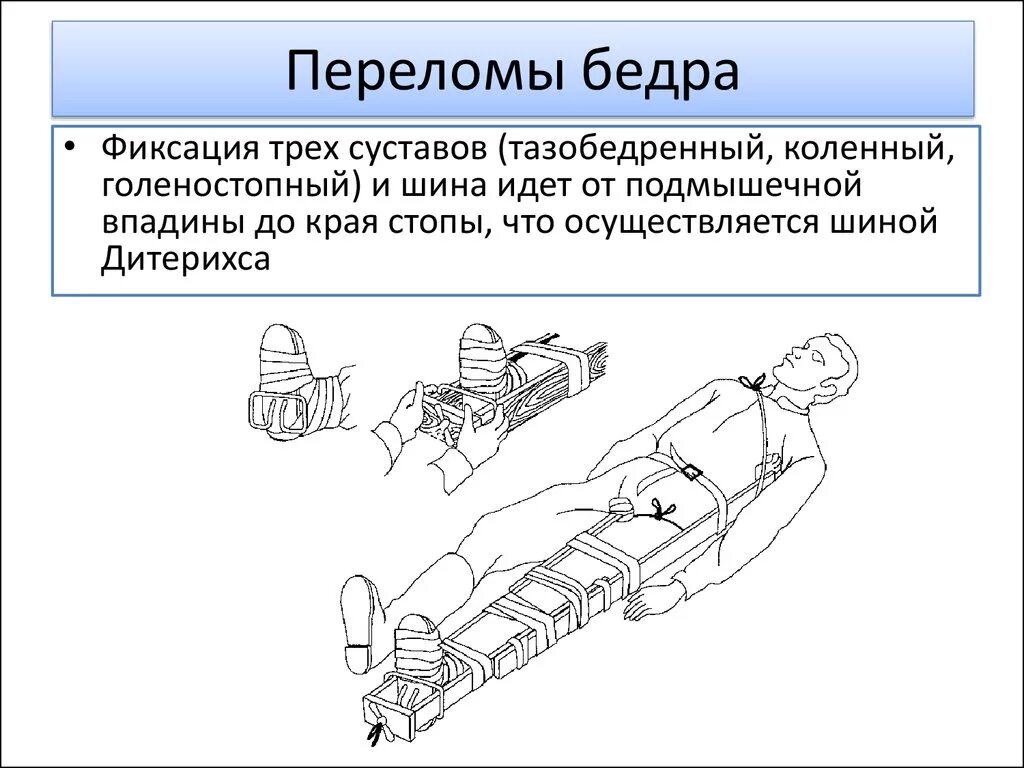 При переломе бедра шину фиксируют. При переломе бедра следует зафиксировать суставы. Фиксация суставов при переломе бедра. При переломе бедренной кости фиксируют:.