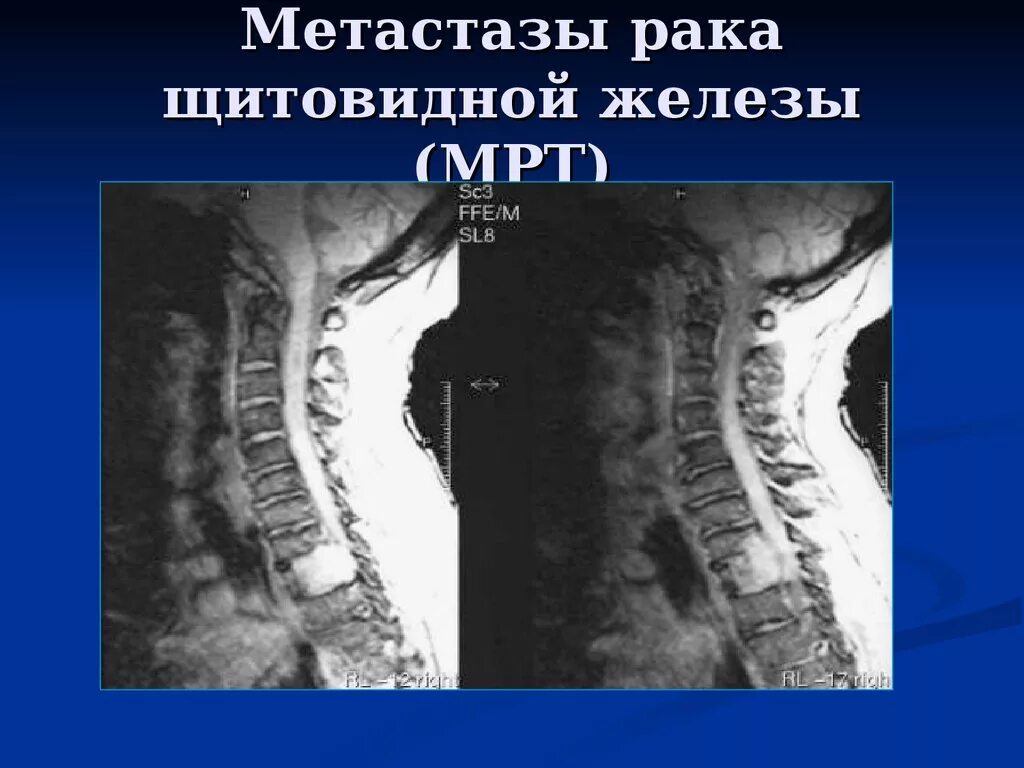 Метастазы опухоли щитовидной железы. Рентгенодиагностика заболеваний позвоночника. Метастазы карциномы щитовидной железы. Метастазы в позвоночнике на мрт.