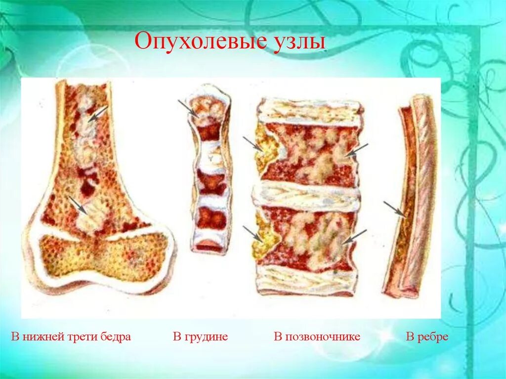 Костный мозг какие заболевания. Миеломная болезнь костный мозг. Миеломная болезнь дырки в костях.