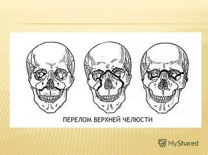 Переломы верхней