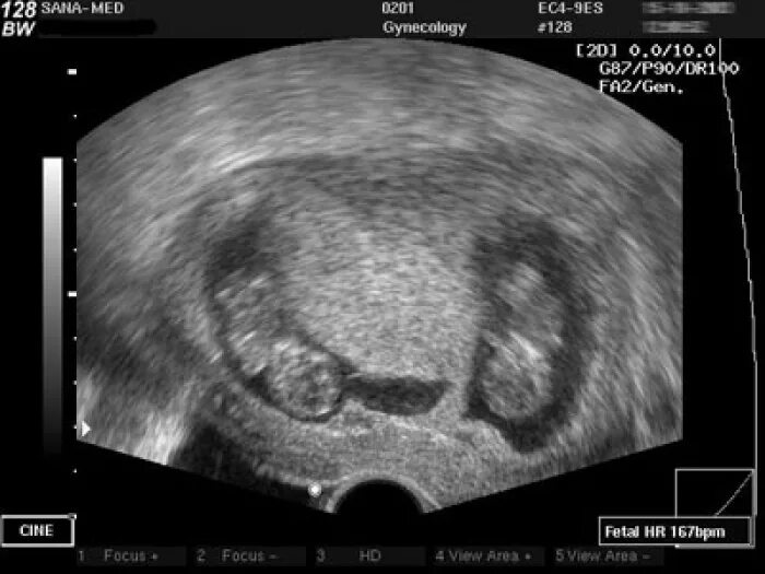 На какой неделе видно двойню. Узи 4 недели беременности близнецы. На какой неделе видно двойню. На какой неделе видно двойню. Близнецы на узи на раннем сроке беременности.